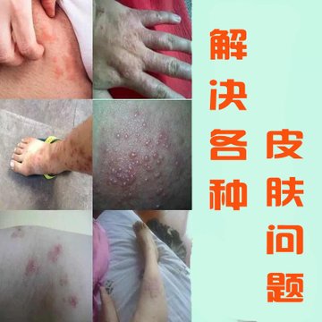湿疹止痒去根药膏外用皮炎性瘙痒皮肤专用治疗屁股肛门顽固廯湿疹黄色
